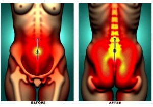 Acupuncture Weight Loss Studies Document Reduced Visceral Fat Measured by MRI Imaging